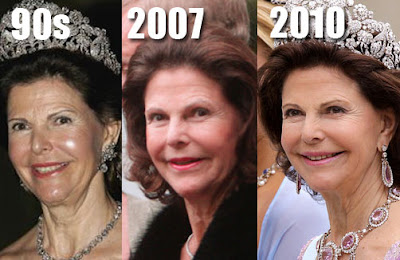 Plastic Surgery  on Silvia Of Sweden   Royal Plastic Surgery    Cosmetic Plastic Surgery