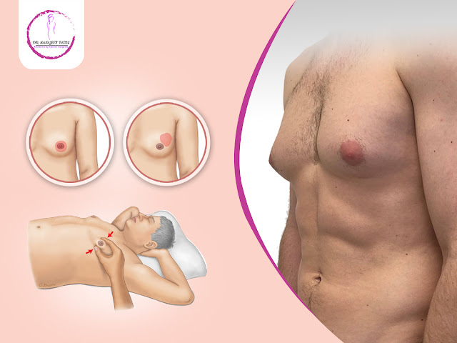 gynecomastia treatment