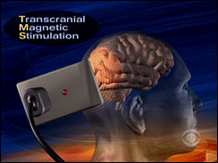 Transcranial Magnetic Stimulation