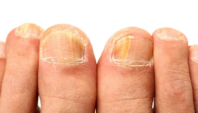 fungal nail infection