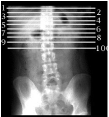Medical Instrumentation: CT (computed tomography) scan