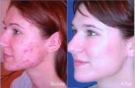 acne treatment in delhi