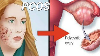 पॉलीसिस्टिक ओवरी सिंड्रोम ( PCOS )