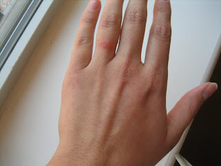 Finger peeling under wedding ring