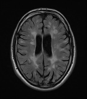 2016 MRI Scan after treatment showing 'calmer' lesions