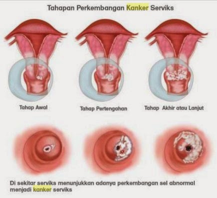 obat kanker serviks alami stadium 2, obat kanker serviks, obat kanker serviks alami stadium 1