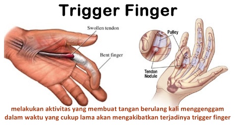 Pengobatan Herbal Alami Trigger Finger