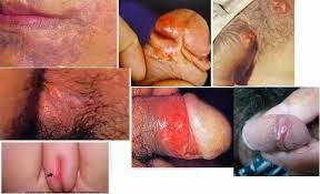 sipilis obat sipilis manjur