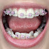 Phương pháp niềng răng cho người trưởng thành