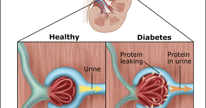 diet for type 2 diabetes and kidney disease