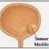 Symptoms of Bladder Tumors and How to Treating ?