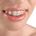 Niềng răng mắc cài sứ thẩm mỹ trong trường hợp nào?