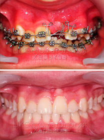 ретенированный зуб кривые зубы неправильный прикус
