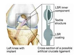 ARTIFICIAL LIGAMENT