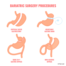  Exploring Surgical Options for Weight Management: A Comprehensive Guide