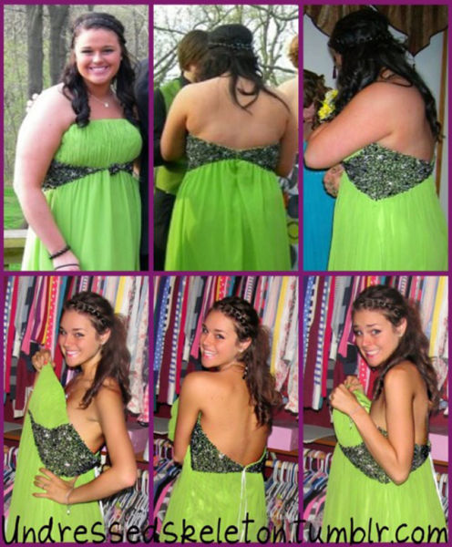 Extreme Weight Loss ~ Damn Cool Pictures