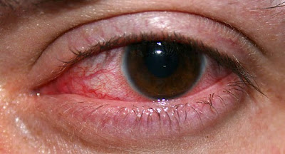  Penyakit mata sanggup terdiri dari beberapa kategori dan faktor penyebab Cara Merawat & Mengatasi Sakit Mata Merah (Konjungtivitis)