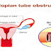 Dealing with Tubal Blockage while Trying to Conceive?