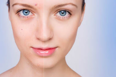  Top 7 Mistakes in Treating Acne. 