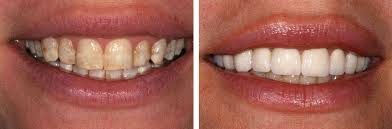 Răng bị nhiễm kháng sinh - Cách điều trị tốt nhất-2