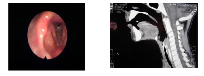 laryngeal-stenosis