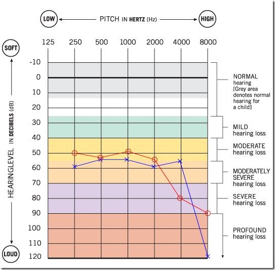 o3x4audiogram