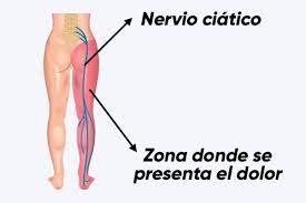 Descubre Soluciones Naturales para Problemas de Ciática: Alivio Efectivo sin Efectos Secundarios