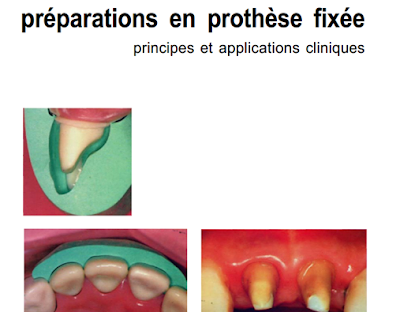 Prothèse,Fixée