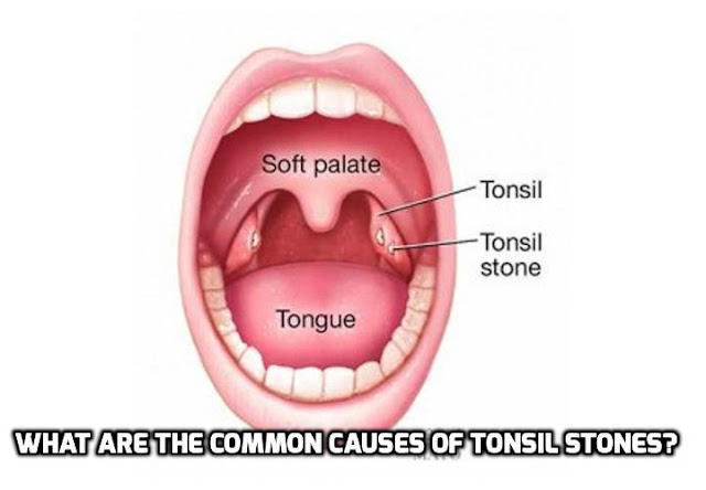 The number of adults with tonsil stones is rising, and researchers suspect this is a result of the large amount of individuals who have not had their tonsils surgically removed. Read on here to find out what are the common causes of tonsil stones.