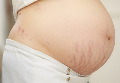 Nguyên nhân rạn da bụng khi mang thai