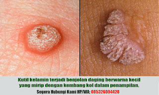 Obat Kutil Kelamin, Obat Kutil Kelamin Wanita, Obat Kutil Kelamin pria, Obat Kutil Kelamin Ibu Hamil, Obat Kutil Kelamin Di Apotik, obat kutil kelamin alami paling ampuh, obat kutil kelamin herbal, obat kutil kelamin de nature, obat kutil kelamin dokter, obat kutil kelamin kimia farma k24, obat kutil kemaluan, cara mengobati kutil kelamin, cara menghilangkan kutil kelamin, obat kutil kelamin  dubur anus selangkangan paha, pengobatan kutil kelamin