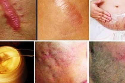 EXPEL ANY TYPE OF SCAR ON YOUR BODY IN LESS THAN A MONTH WITH THIS POWERFUL NATURAL REMEDY