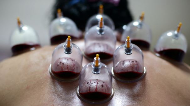 illnesses that are treated by cupping therapy