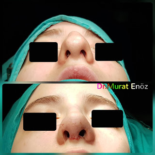 Female Rhinoplasty Istanbul Turkey, Nose Job in Women, Rhinoplasty Istanbul