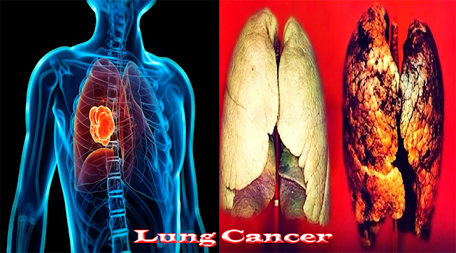 Reduce Lung Cancer Risk Without Medicine
