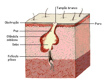 O que fazer para evitar espinhas na minha pele?