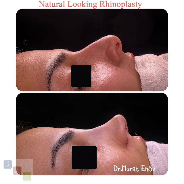 subtle enhancements,Istanbul aesthetic procedure,Istanbul natural rhinoplasty,natural-looking results,harmonious nose job.,Turkey organic nose surgery,skilled surgeons,