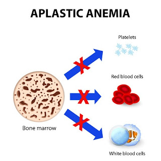 Cara alami menyembuhkan anemia aplastik