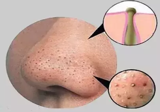 Remove Blackheads Permanently