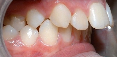 Các phương pháp niềng răng hô