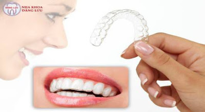 Chi phí niềng răng không mắc cài 3D