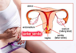 Ketahui Penyebab kanker serviks dan ciri cirinya