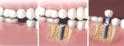 Chi phí cấy ghép Implant nha khoa