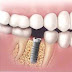 Chi phí cấy ghép Implant nha khoa