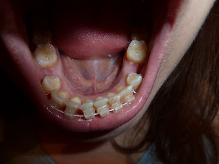 A photograph of lower teeth with ceramic fixed braces at week 10 of treatment