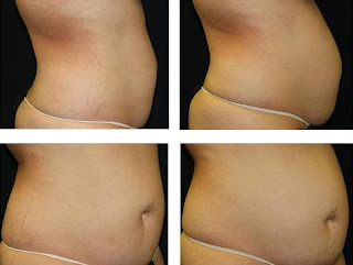 Coolsculpting funciona