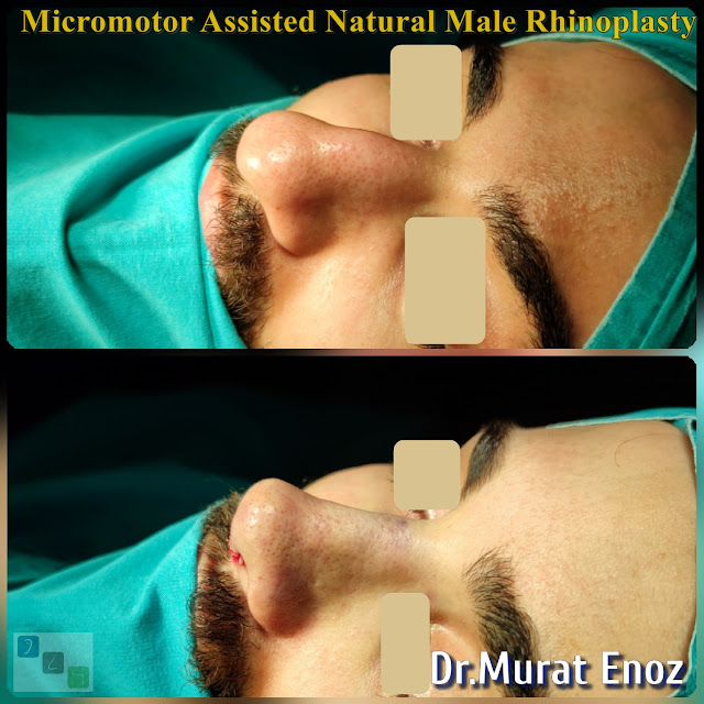 Micro-motor assisted male rhinoplasty - Nose job for men - Crooked nose aesthetic in Istanbul