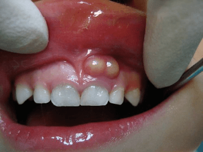 Triệu chứng của bệnh sưng chân răng không đau 