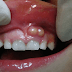 Triệu chứng của bệnh sưng chân răng không đau 