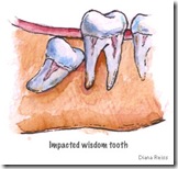 odontectomy